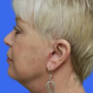 Face Lift before and after photos