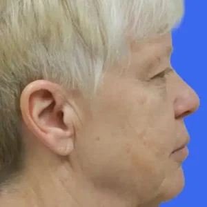 Face Lift before and after photos