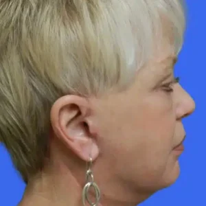 Face Lift before and after photos