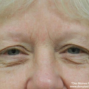 Eyelid Surgery before and after photos