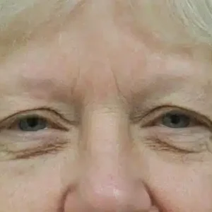 Eyelid Surgery before and after photos