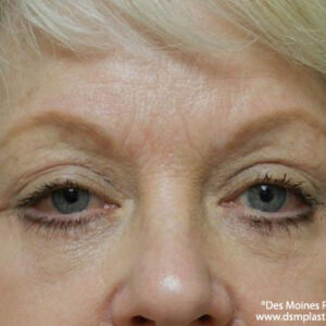 Eyelid Surgery before and after photos