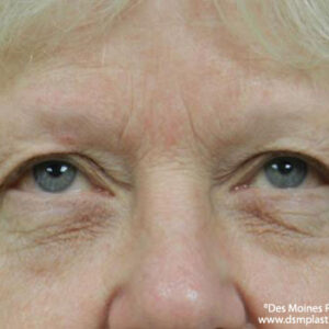 Eyelid Surgery before and after photos