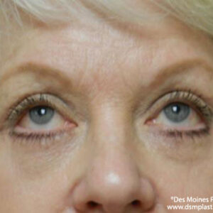 Eyelid Surgery before and after photos