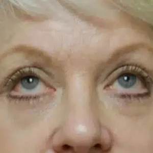 Eyelid Surgery before and after photos