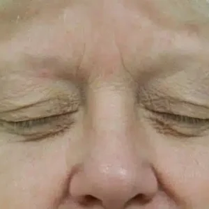 Eyelid Surgery before and after photos