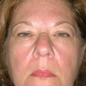 Brow Lift before and after photos