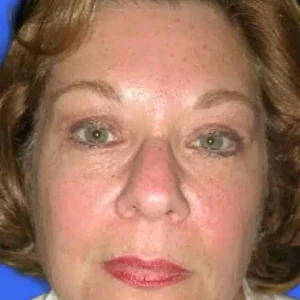 Brow Lift before and after photos