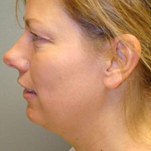 Neck Liposuction before and after photos