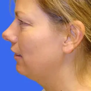 Neck Liposuction before and after photos