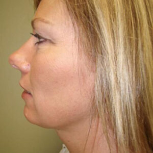 Neck Liposuction before and after photos