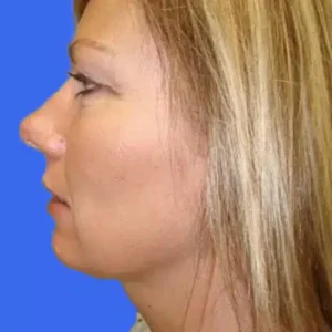 Neck Liposuction before and after photos