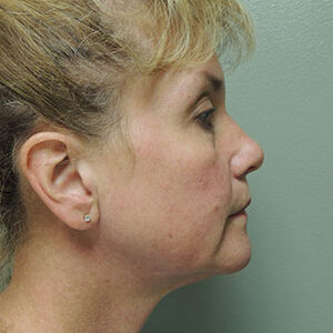 Laser Lift before and after photos