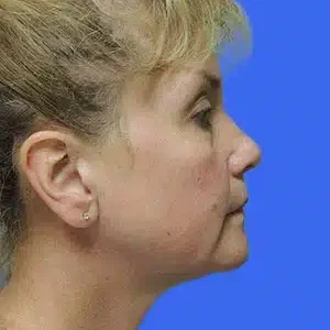 Laser Lift before and after photos