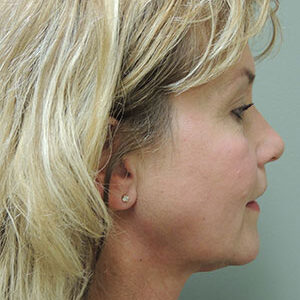 Laser Lift before and after photos