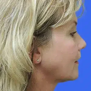 Laser Lift before and after photos