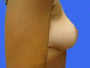 Breast Lift before and after photos Breast Lift before and after photos