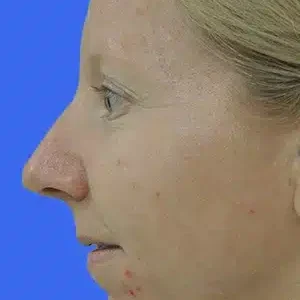 Rhinoplasty before and after photos