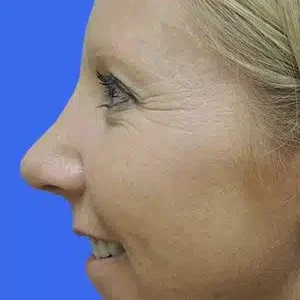 Rhinoplasty before and after photos