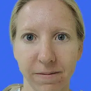 Rhinoplasty before and after photos