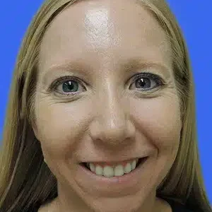 Rhinoplasty before and after photos