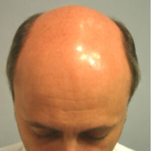 Neograft Hair Loss Replacement before and after photos