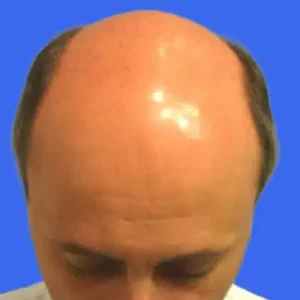 Neograft Hair Loss Replacement before and after photos