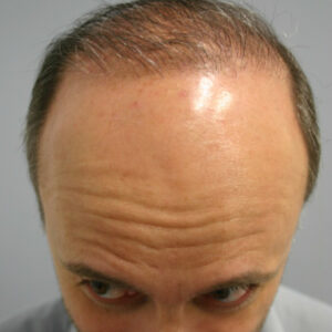 Neograft Hair Loss Replacement before and after photos