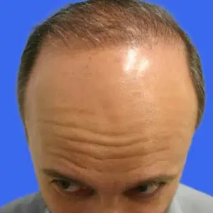 Neograft Hair Loss Replacement before and after photos