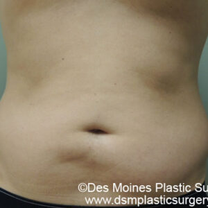 Liposuction before and after photos