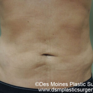 Liposuction before and after photos