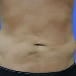 Liposuction before and after photos Liposuction before and after photos