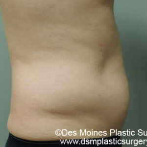 Liposuction before and after photos