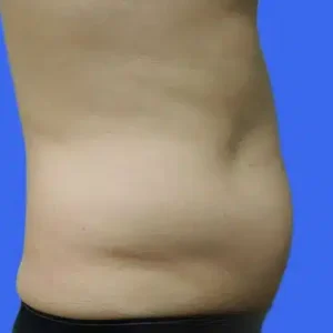 Liposuction before and after photos Liposuction before and after photos