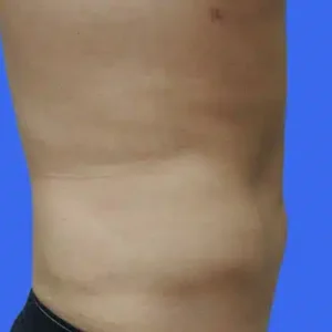 Liposuction before and after photos Liposuction before and after photos