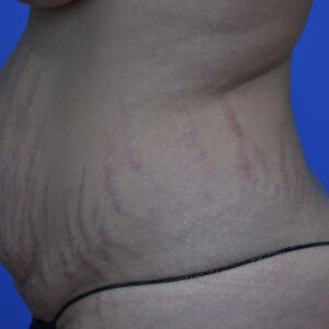 Tummy Tuck before and after photos