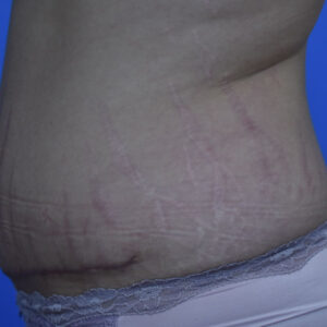 Tummy Tuck before and after photos