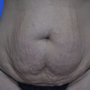 Tummy Tuck before and after photos