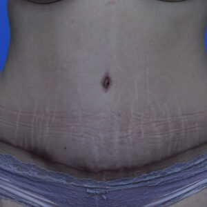 Tummy Tuck before and after photos