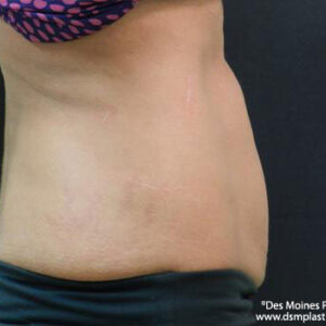 CoolSculpting before and after photos