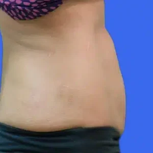 CoolSculpting before and after photos CoolSculpting before and after photos