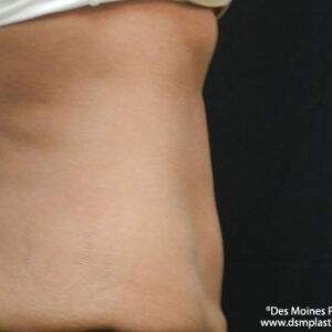 CoolSculpting before and after photos