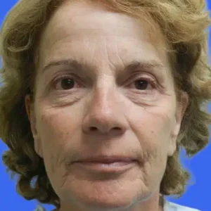 Face Lift before and after photos