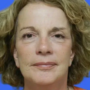 Face Lift before and after photos