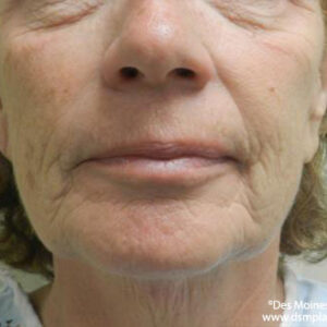 Face Lift before and after photos