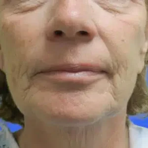 Face Lift before and after photos