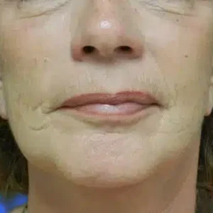 Face Lift before and after photos