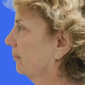 Face Lift before and after photos