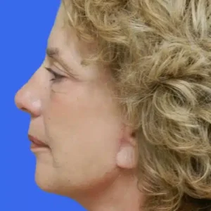 Face Lift before and after photos