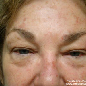 Eyelid Surgery before and after photos